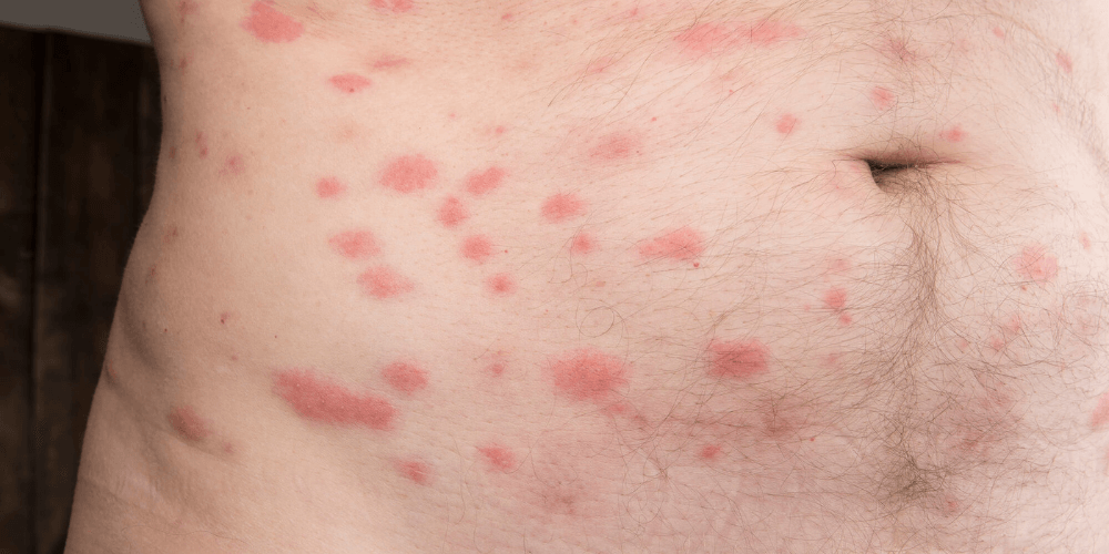 Sign 1_ Visible Bed Bug Bites