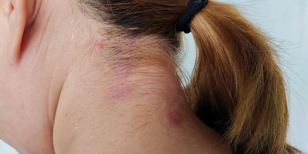 Signs of Bed Bugs Near Your Hair